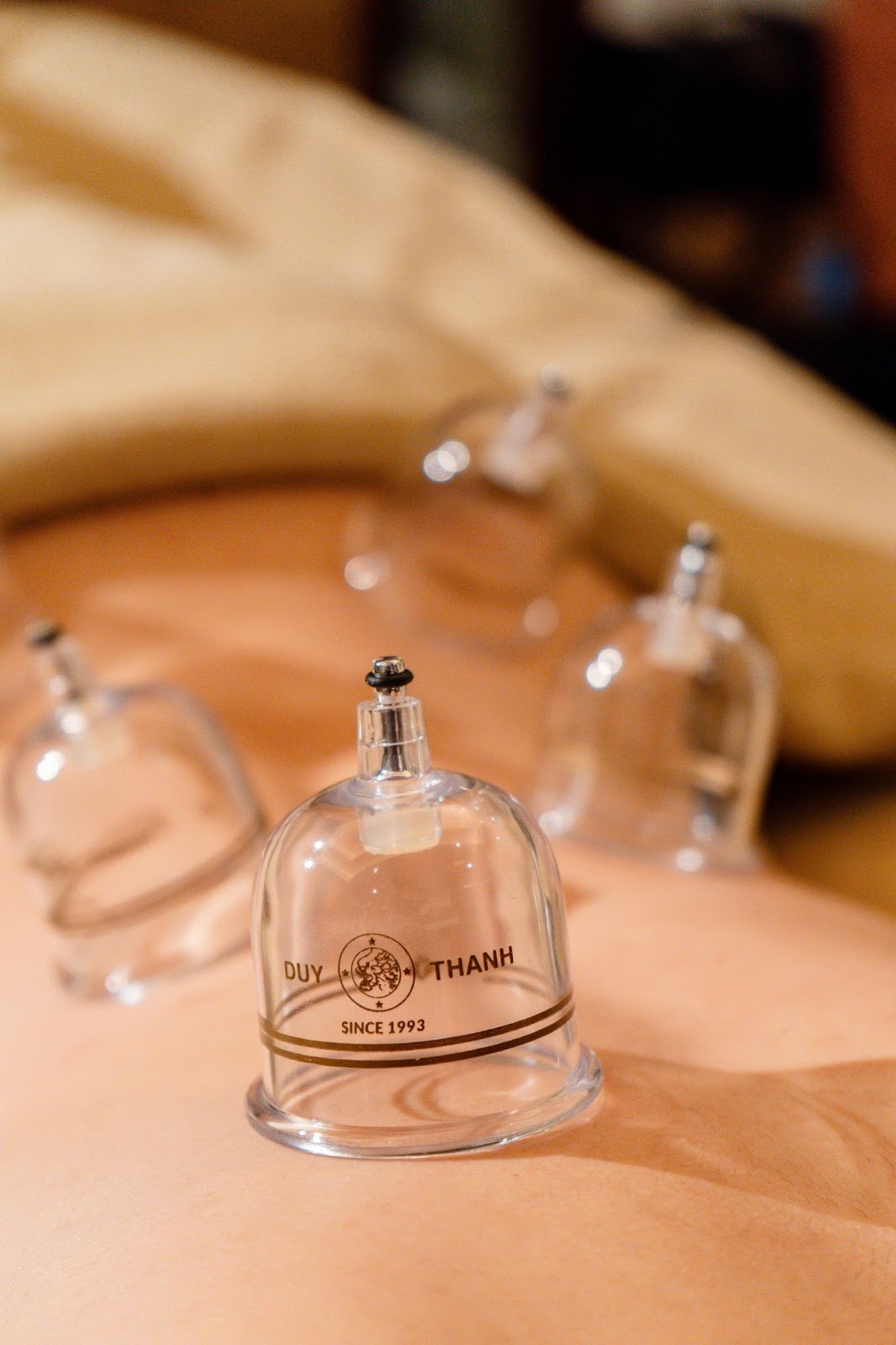 V-Senses Wellness & Spaでの伝統的なウェルネストリートメント中に、ゲストの背中に置かれたDuy Thanhガラス製カッピングカップのクローズアップ。